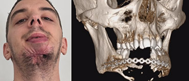 chirurgie de guerre traumatisme facial par balle