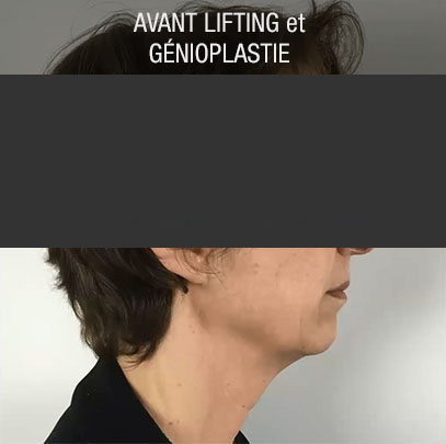 avant lifting et génioplastie