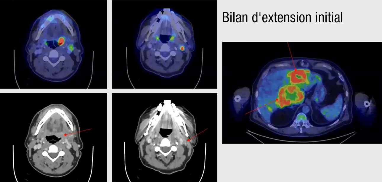 Bilan d'extension initial