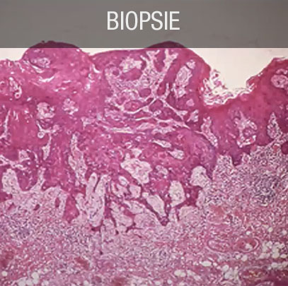 biopsie diagnostic cancer buccal