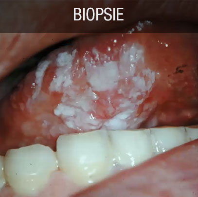 biopsie cancer buccal