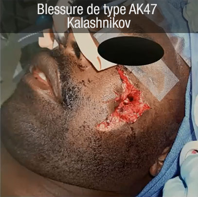 blessure AK47