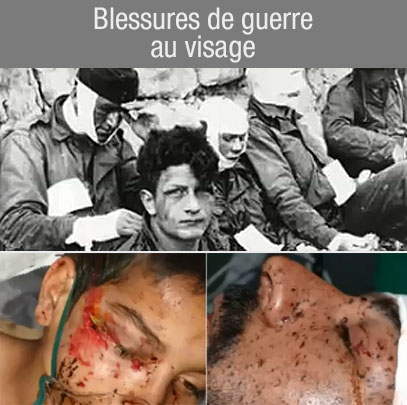 blessures de guerre au visage