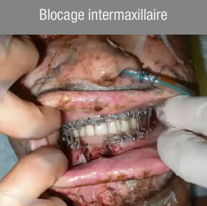 Blocage intermaxillaire