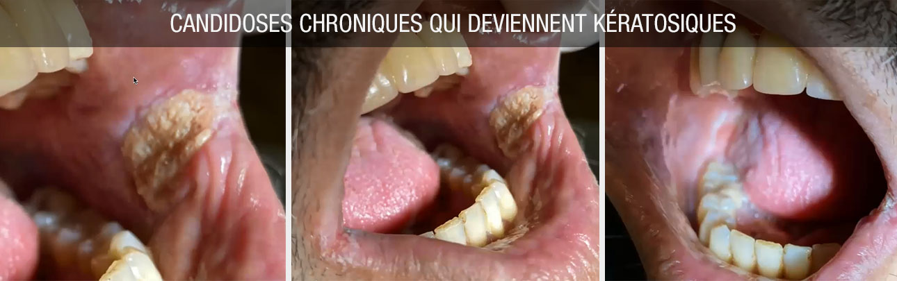 candidoses chroniques qui deviennent kératosiques