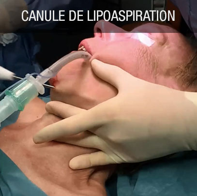 canule de lipoaspiration