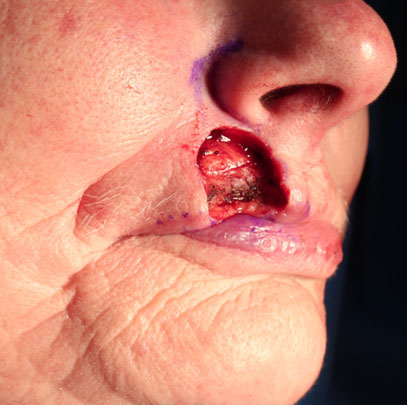 Carcinome basocellulaire de la lèvre supérieure