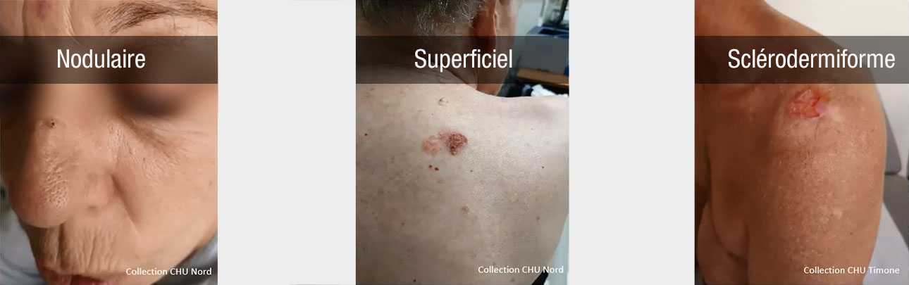 carcinome basocellulaire