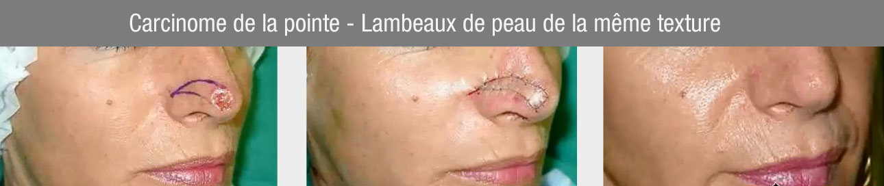 Carcinome de la pointe - Lambeaux de peau de la même texture