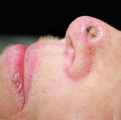 carcinome épidermoïde de la pointe du nez