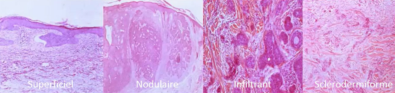 Carcinome basocellulaire CBC sous-types histologiques