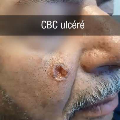 cbc ulcération