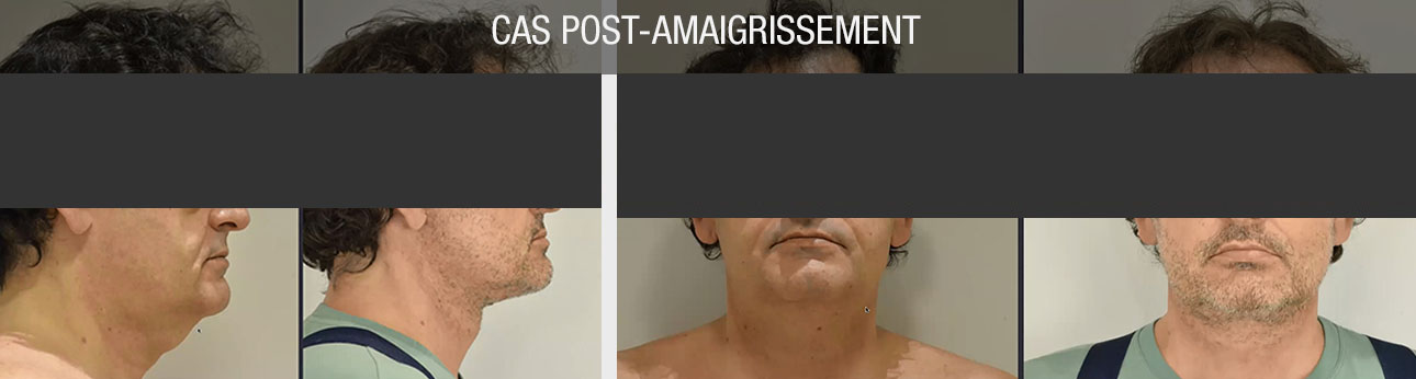 chirurgie esthétique post amaigrissement