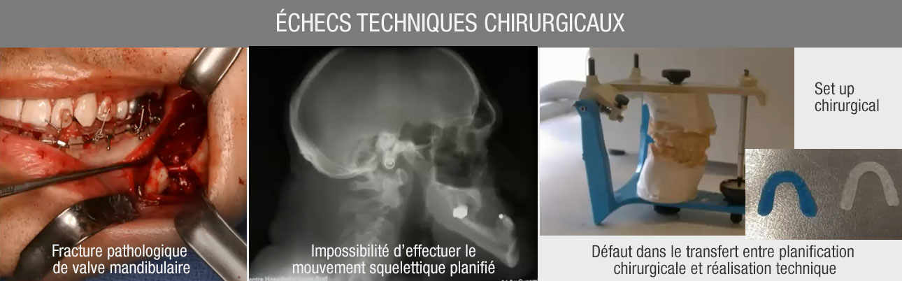 échecs chirurgie orthognathique