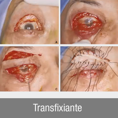 reconstruction paupière supérieure transfixiante