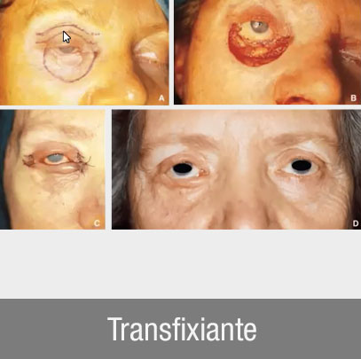 reconstruction paupières transfixiante