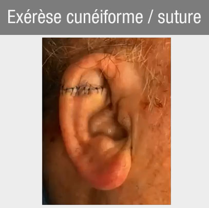 exérèse cunéiforme suture