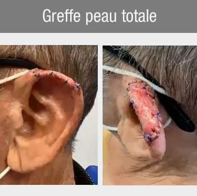 chirurgie oreille greffe peau totale