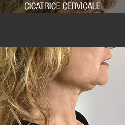 cicatrice cervicale