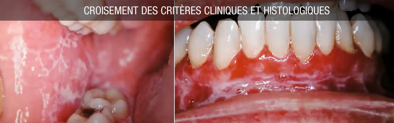 Croisement critères cliniques histologiques