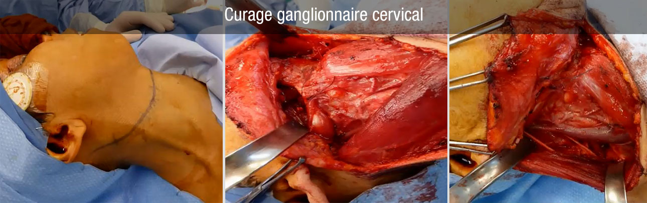 Curage ganglionnaire cervical