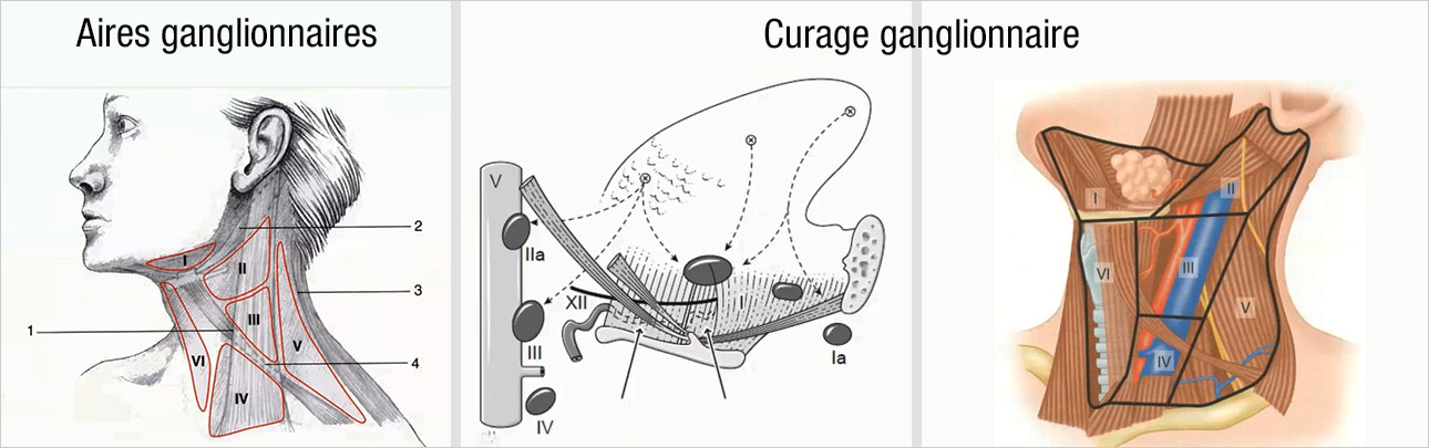 Curage ganglionnaire