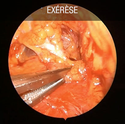 Exérèse lipoaspiration