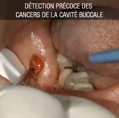 Détection précoce