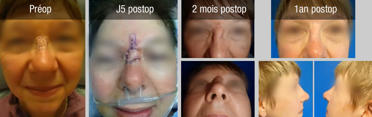 dorsum nasal lambeau glabellaire