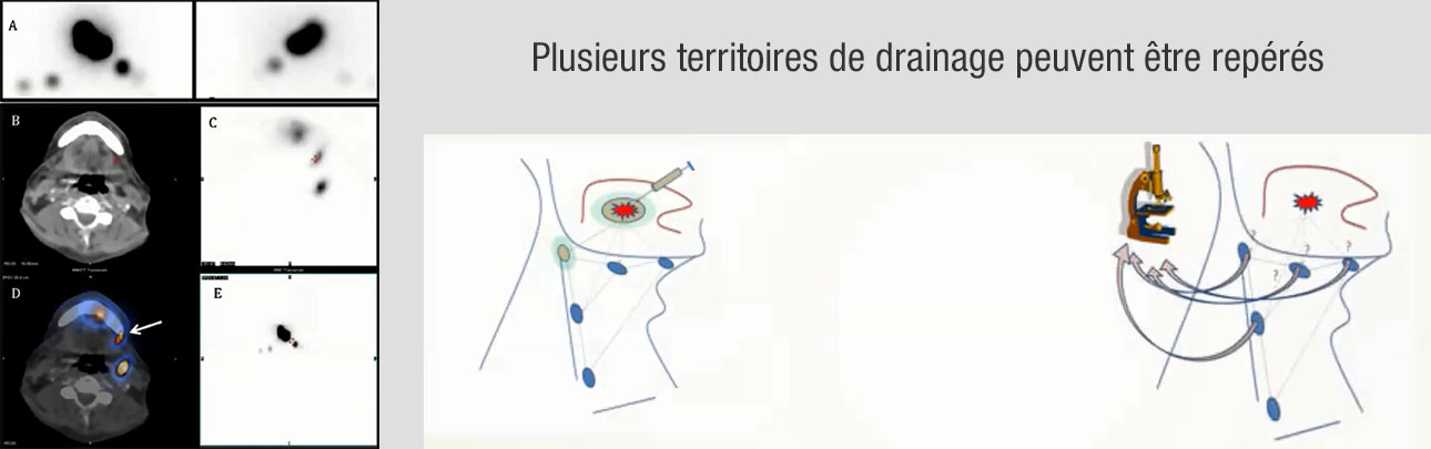 Imagerie et drainage ganglionnaire