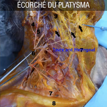 écorché du platysma