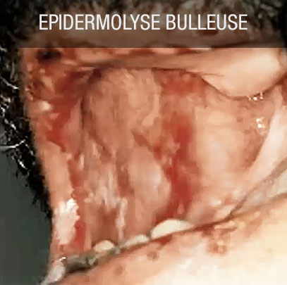 Epidermolyse bulleuse