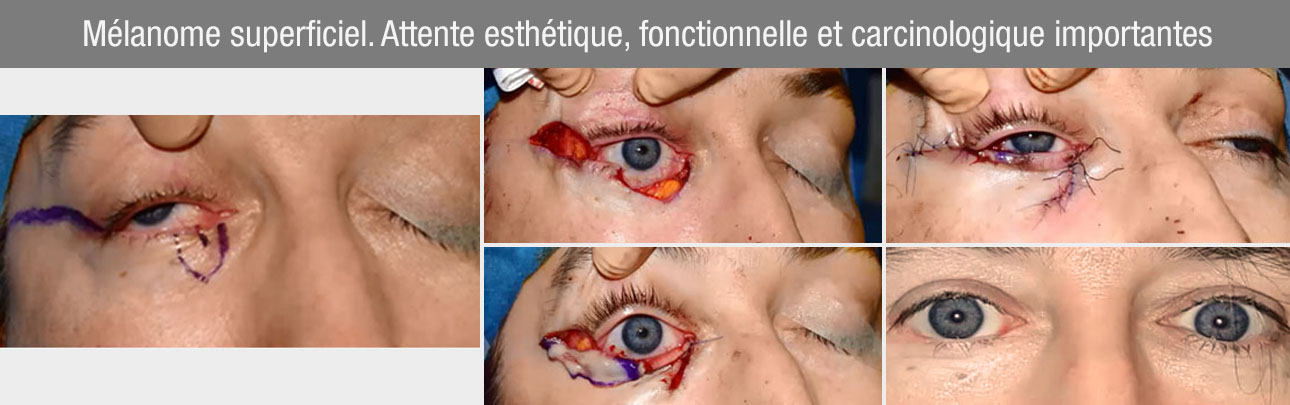 reconstructions difficiles mélanome superficiel