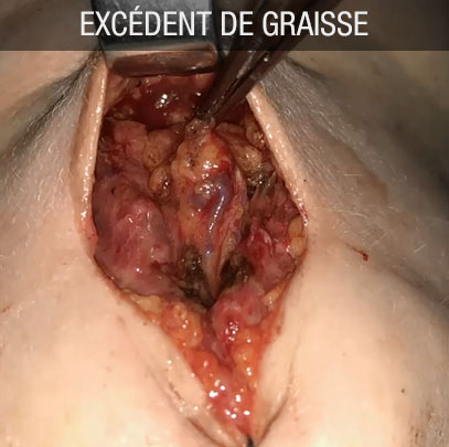 excédent de graisse