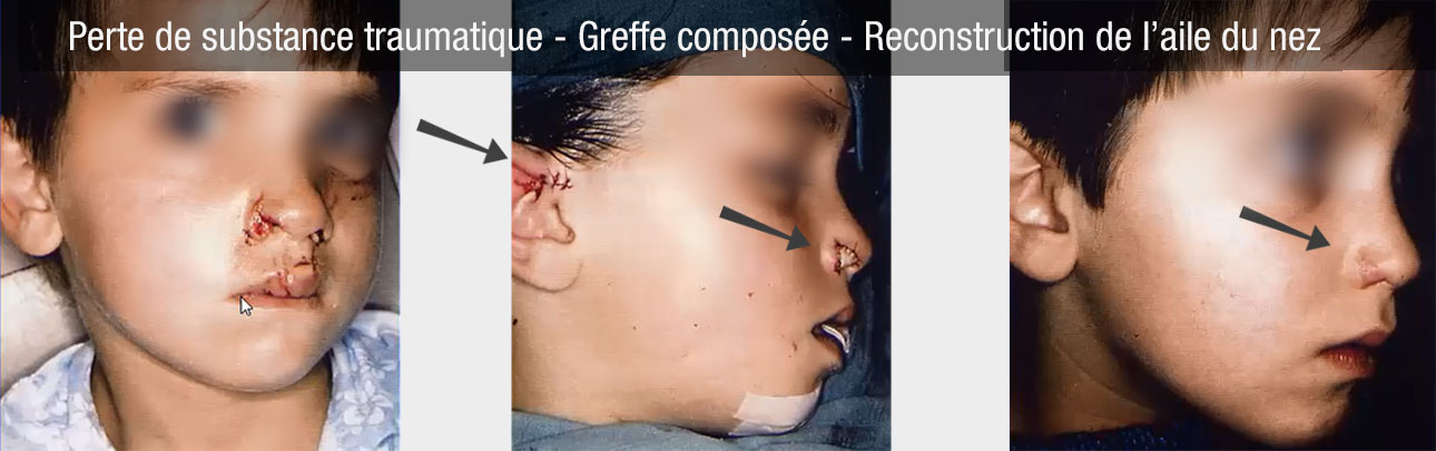 Greffe composée reconstruction de l'aile du nez