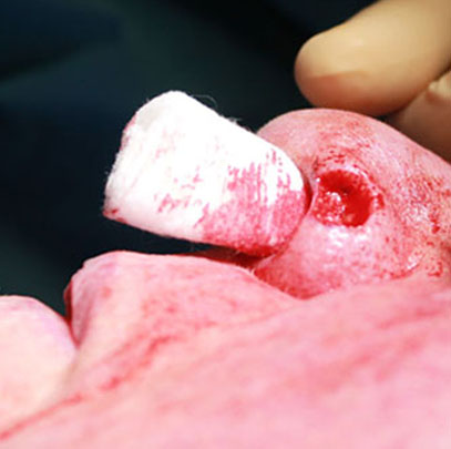 Carcinome basocellulaire de l’aile du nez