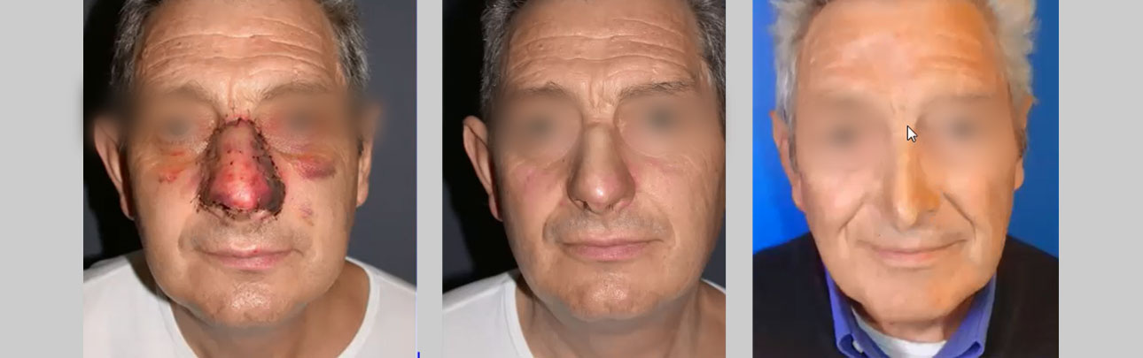greffe de peau totale