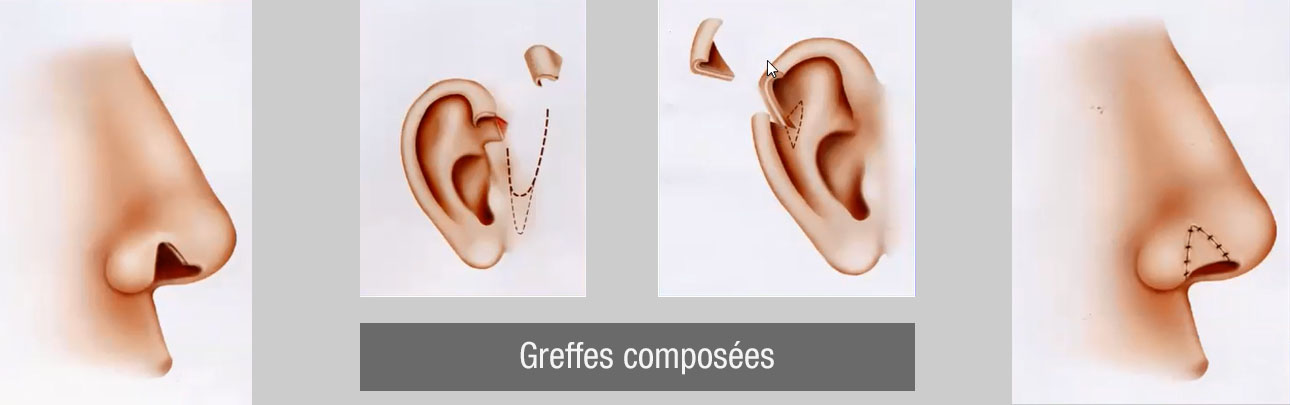 Greffes composées