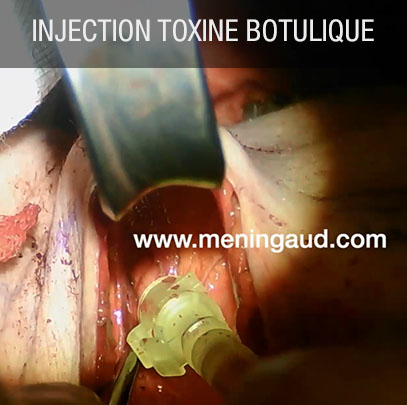 inhection de toxine botulique
