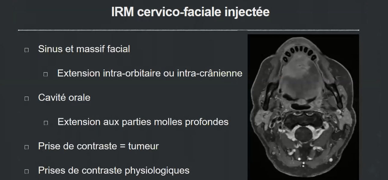 IRM cervico faciale injectée