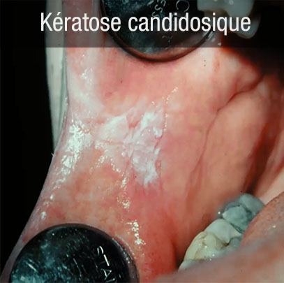 keratose candidosique