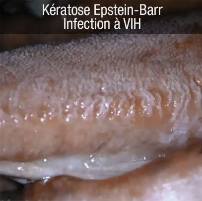 keratose epstein barr VIH