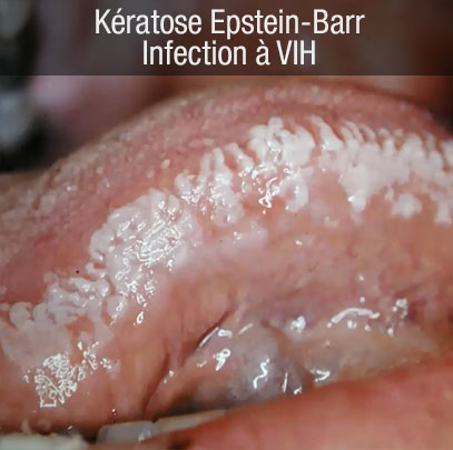 keratose epstein barr VIH