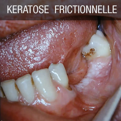 kératose frictionnelle