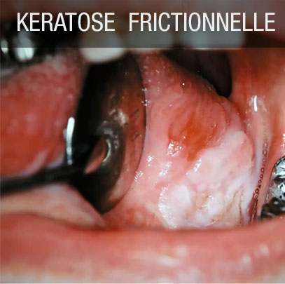 kératose frictionnelle