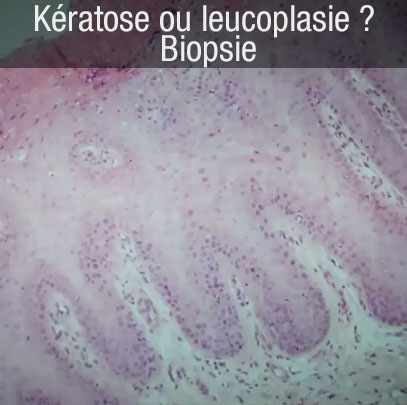 biopsie, kératose ou leucoplasie