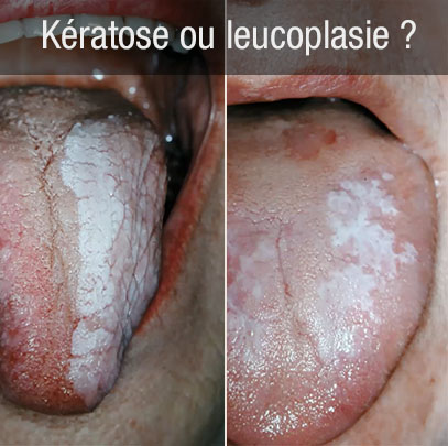 kératose ou leucoplasie