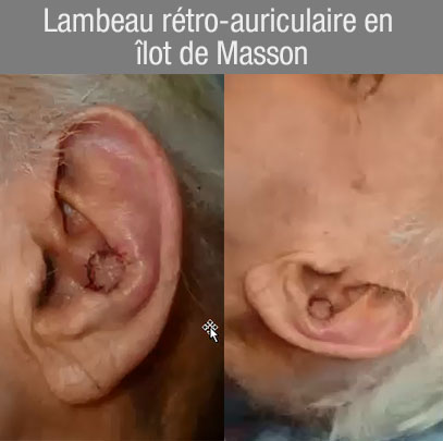 exérèse cunéiforme suture