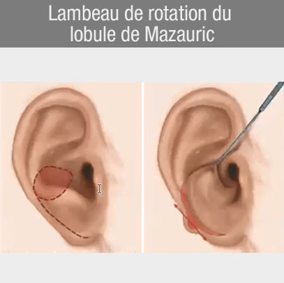 Lambeau de rotation du lobule de Mazauric