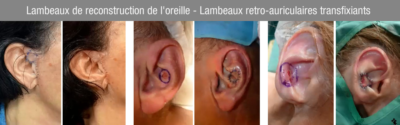 Lambeaux de reconstruction de l'oreille - Lambeaux retro-auriculaires transfixiants